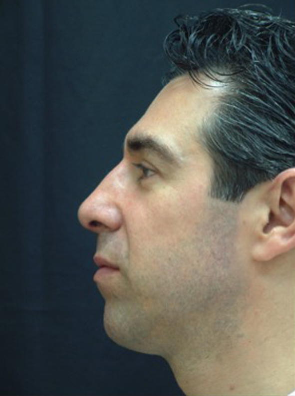 Rhinoplasty result at Beverly Hills Aesthetics