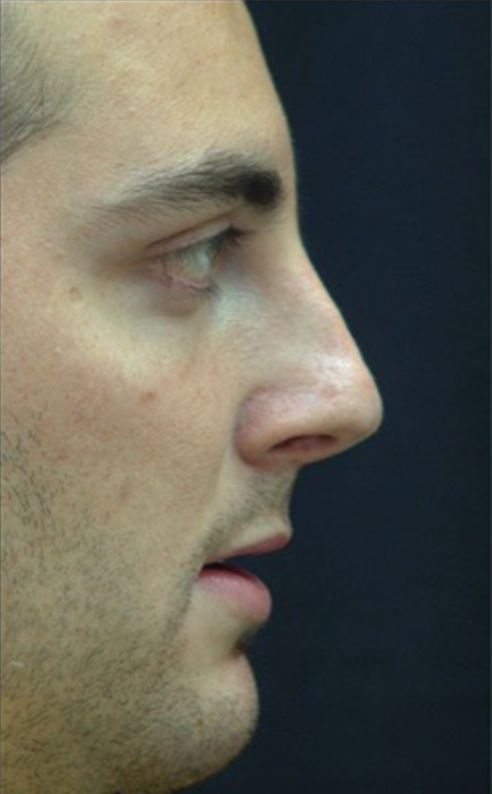 Rhinoplasty result at Beverly Hills Aesthetics