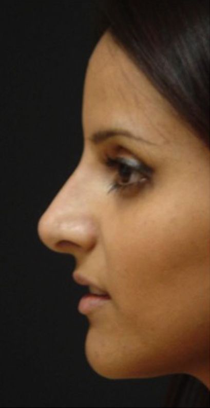 Rhinoplasty result at Beverly Hills Aesthetics