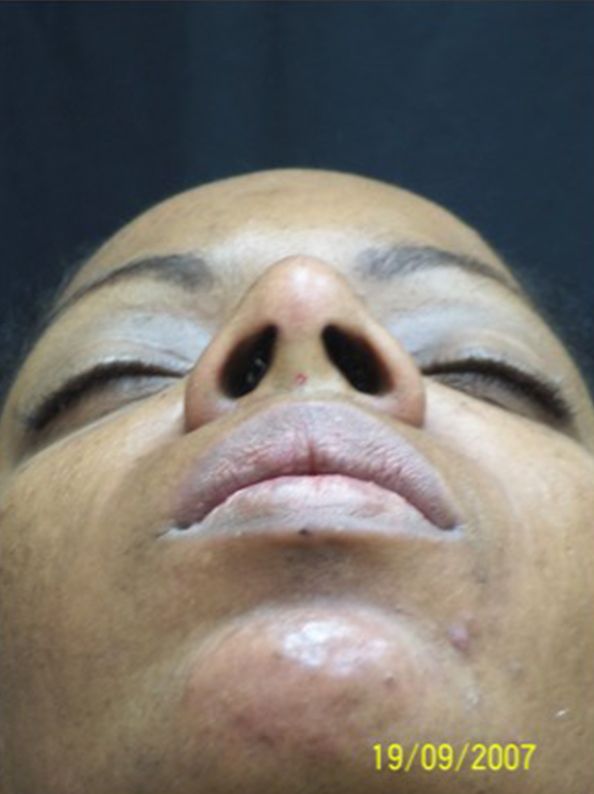 Rhinoplasty result at Beverly Hills Aesthetics