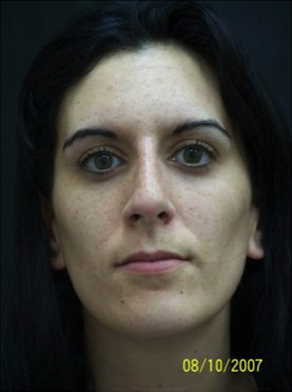 Rhinoplasty result at Beverly Hills Aesthetics