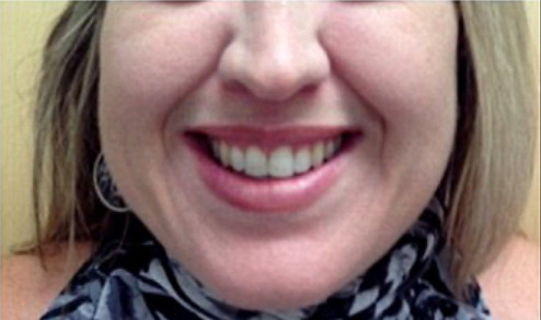 Beverly Hills Aesthetics veneers after — Los Angeles, CA
