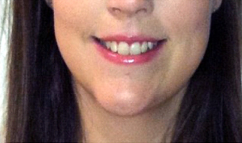 Beverly Hills Aesthetics veneers after — Los Angeles, CA