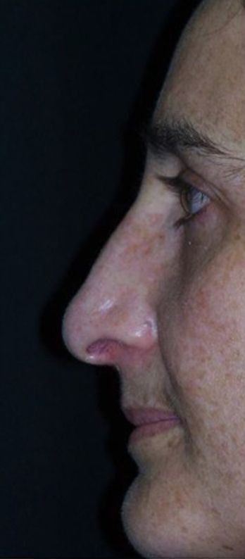 Rhinoplasty result at Beverly Hills Aesthetics