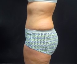 A result from EBS Plastic Surgery