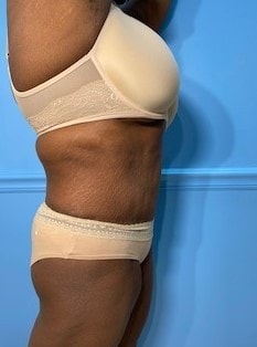 A result from Day Plastic Surgery (Norman Bakshandeh, MD)
