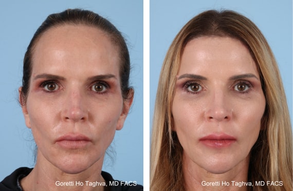 A result from LEA Plastic Surgery - Goretti Ho Taghva MD, FACS