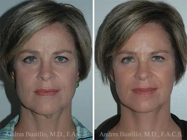 A result from Dr. Andres Bustillo - Facial Plastic Surgery