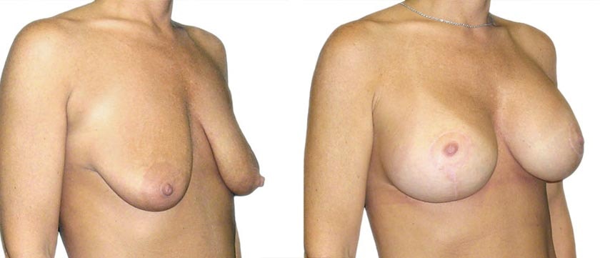 A result from Azouz Plastic & Cosmetic Surgery