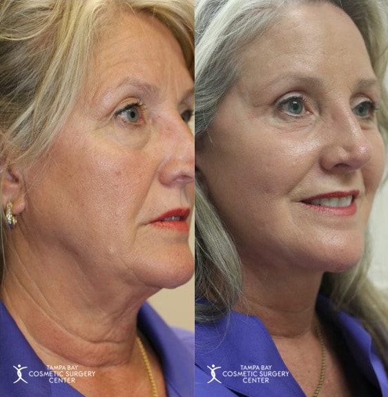 A result from Tampa Bay Cosmetic Surgery Center
