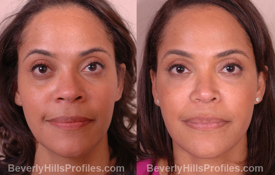 A result from PROFILES Beverly Hills