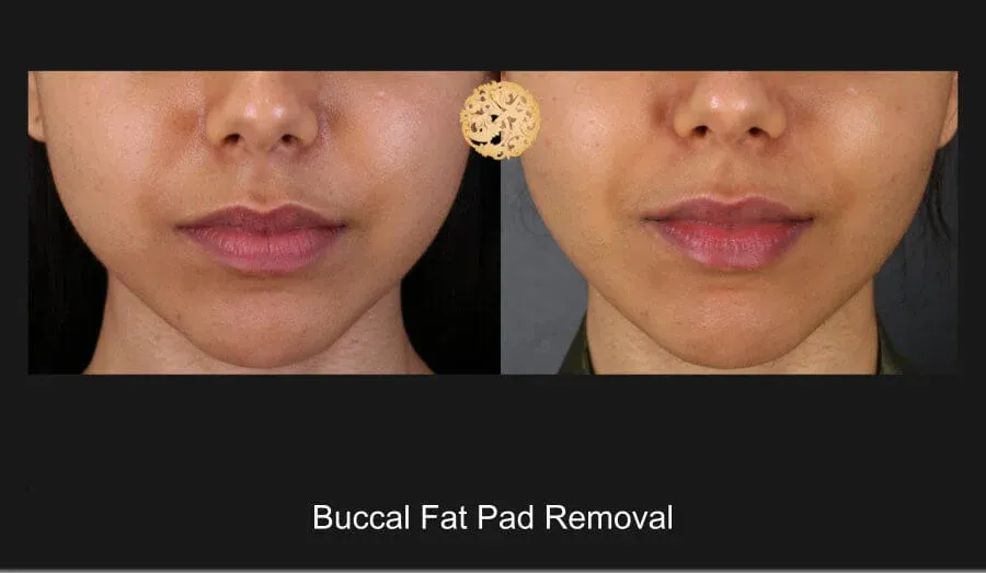 Buccal Fat result at Nazarian Plastic Surgery