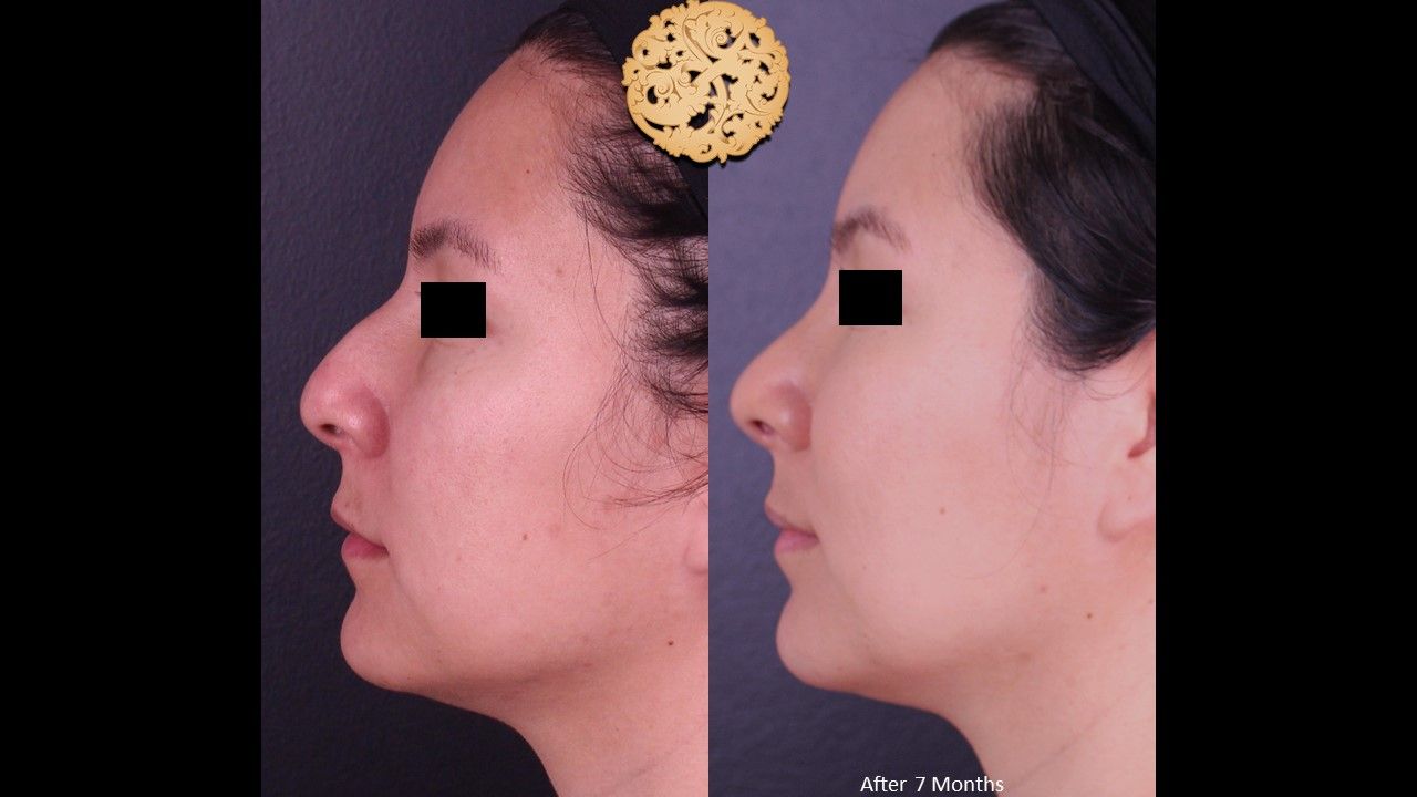 Rhinoplasty result at Nazarian Plastic Surgery