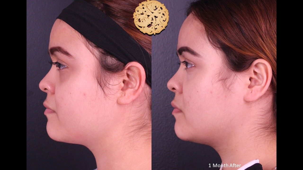 Buccal Fat result at Nazarian Plastic Surgery