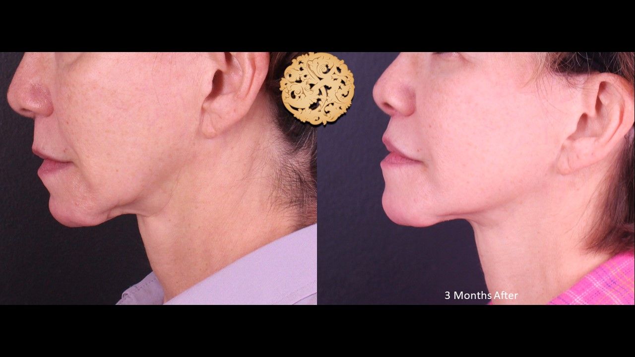 Lip Lift result at Nazarian Plastic Surgery