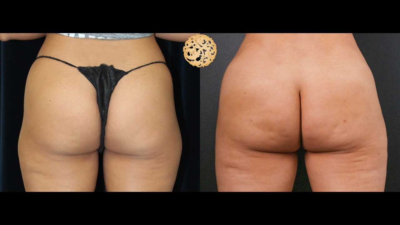 Bbl result at Nazarian Plastic Surgery