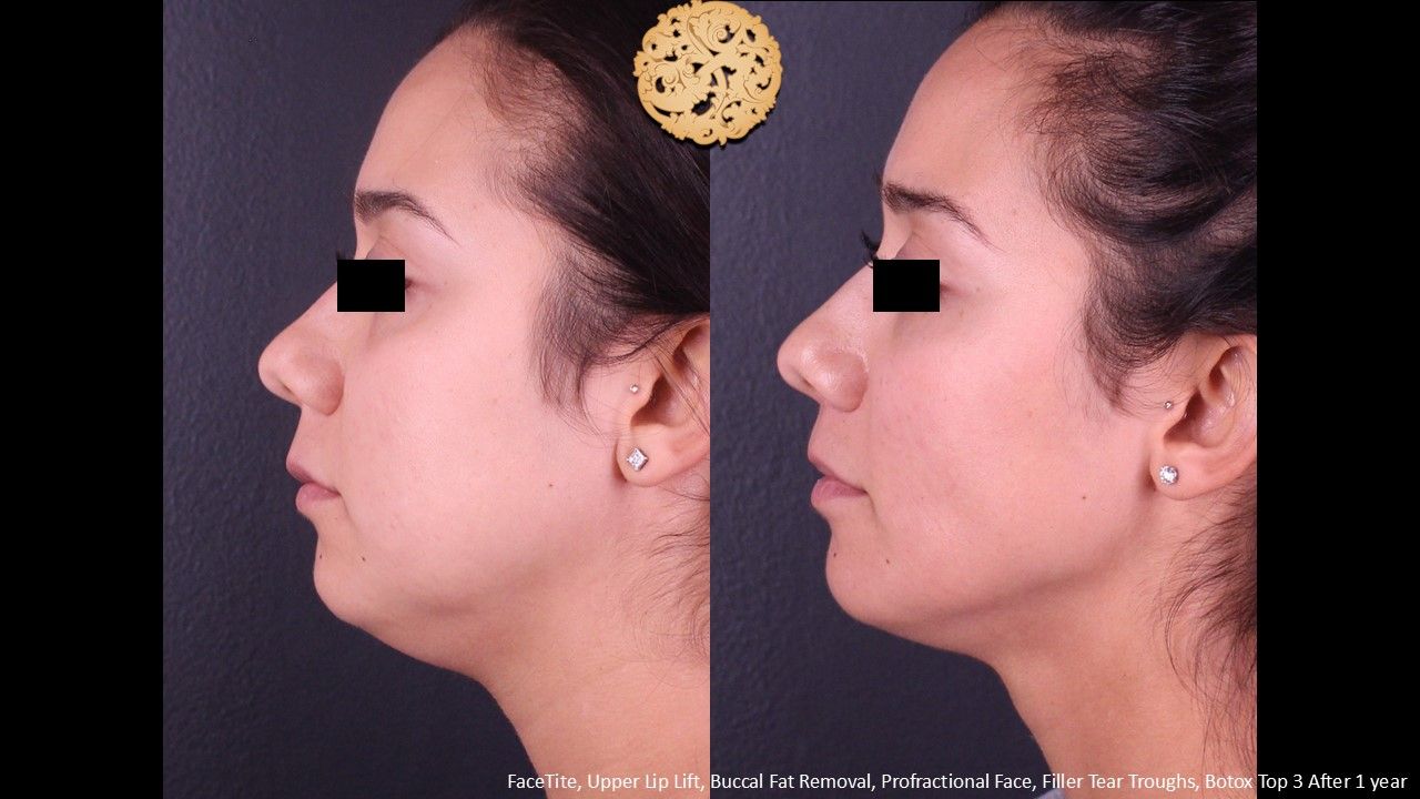 Lip Lift result at Nazarian Plastic Surgery