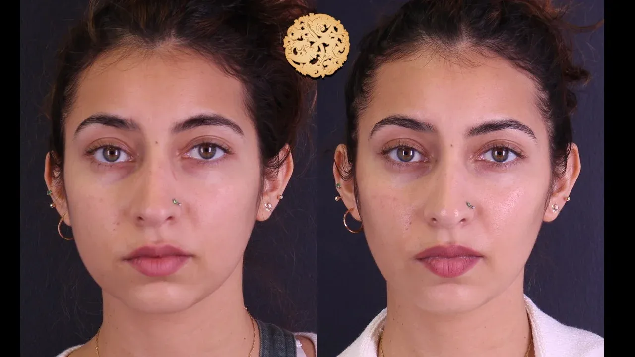 Buccal Fat result at Nazarian Plastic Surgery