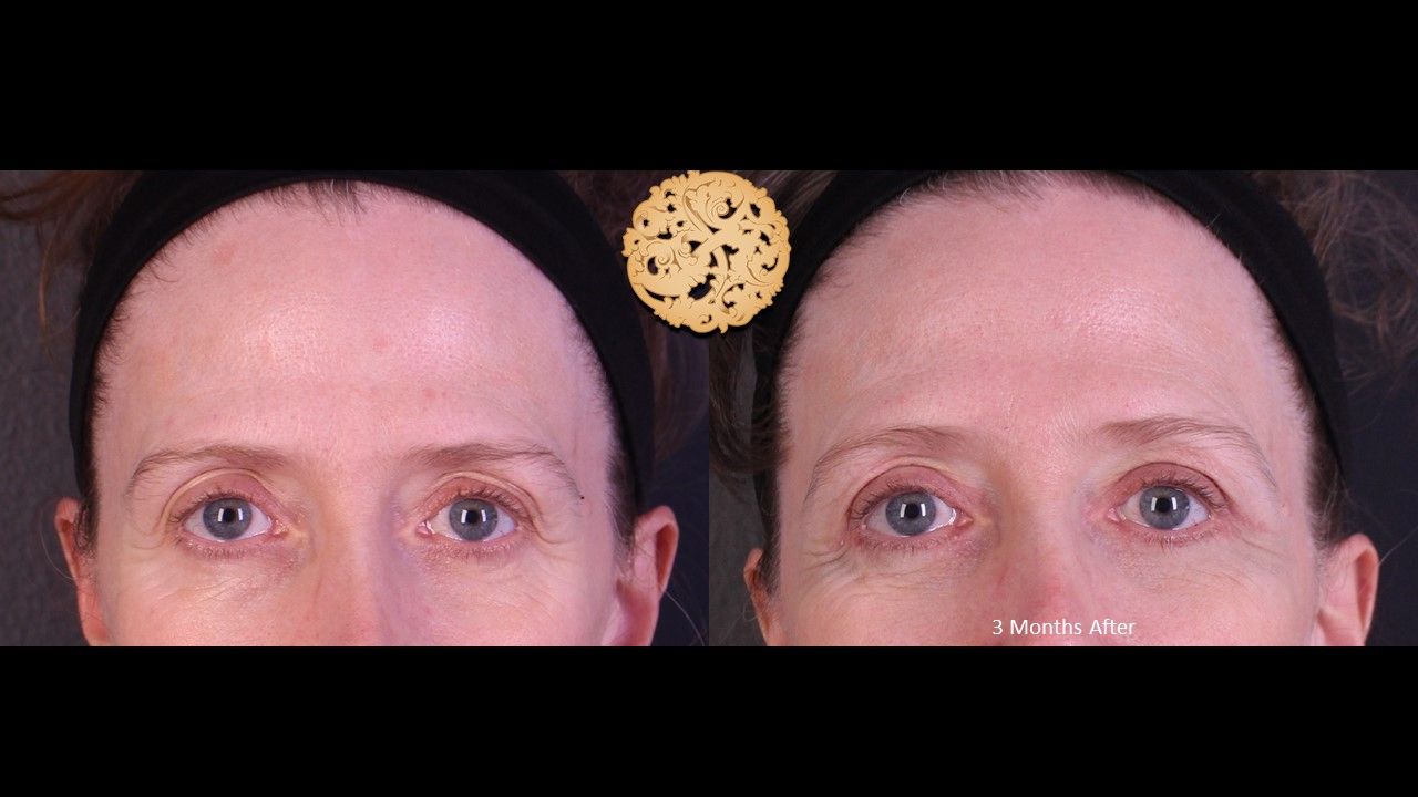 Blepharoplasty result at Nazarian Plastic Surgery
