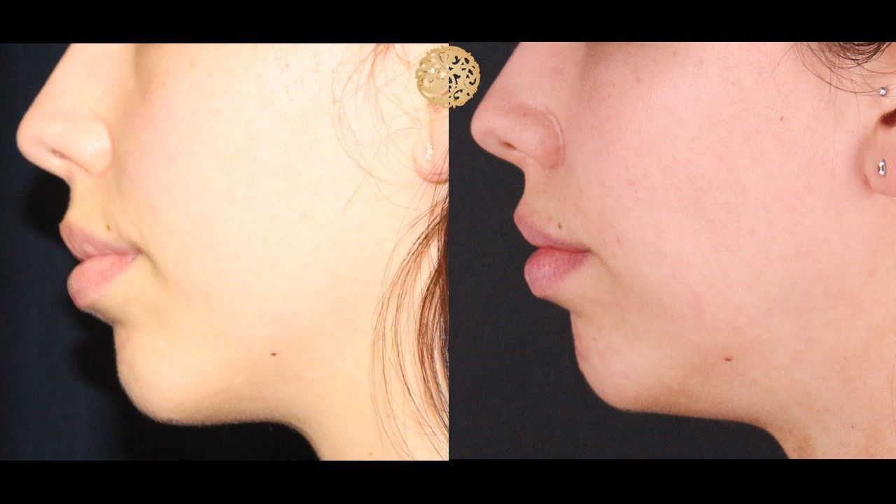 Buccal Fat result at Nazarian Plastic Surgery