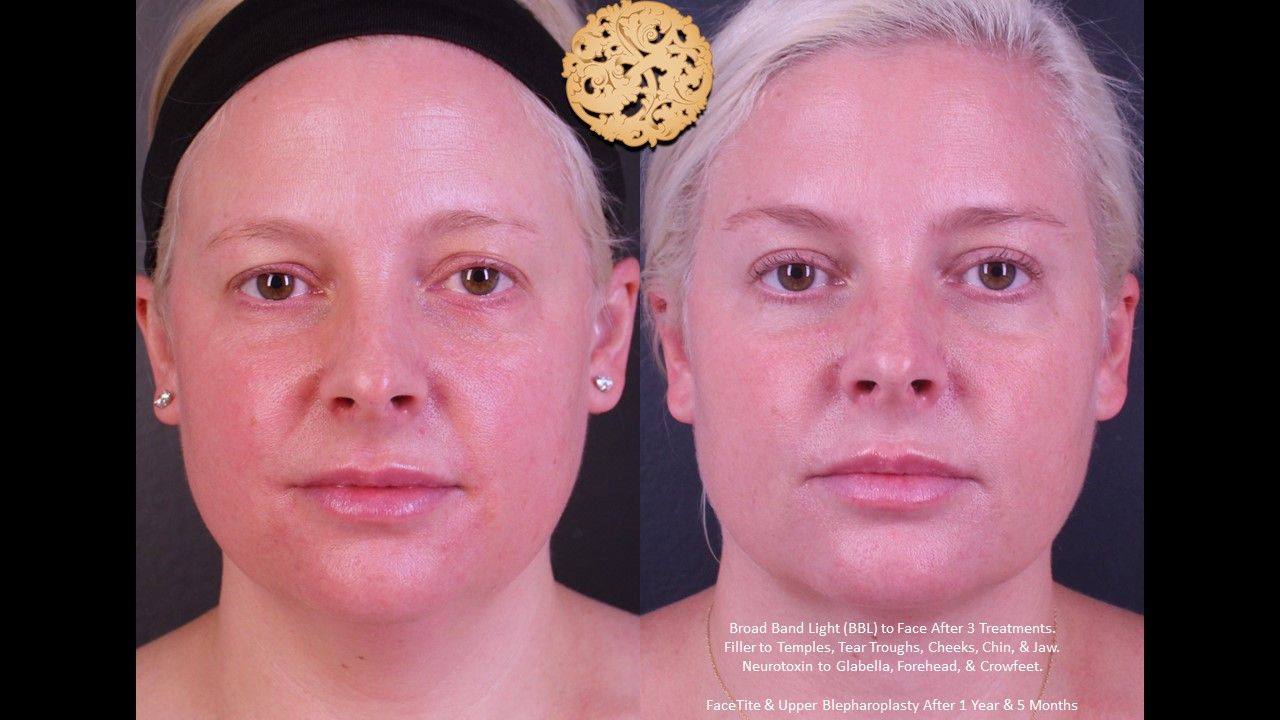 Blepharoplasty result at Nazarian Plastic Surgery