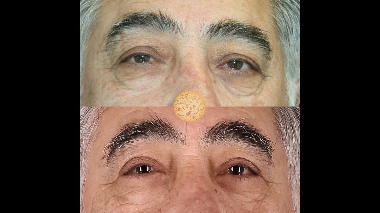 Blepharoplasty result at Nazarian Plastic Surgery