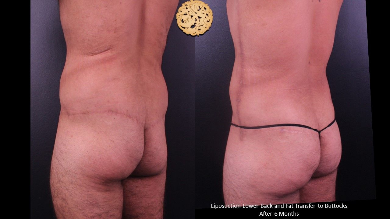 Bbl result at Nazarian Plastic Surgery