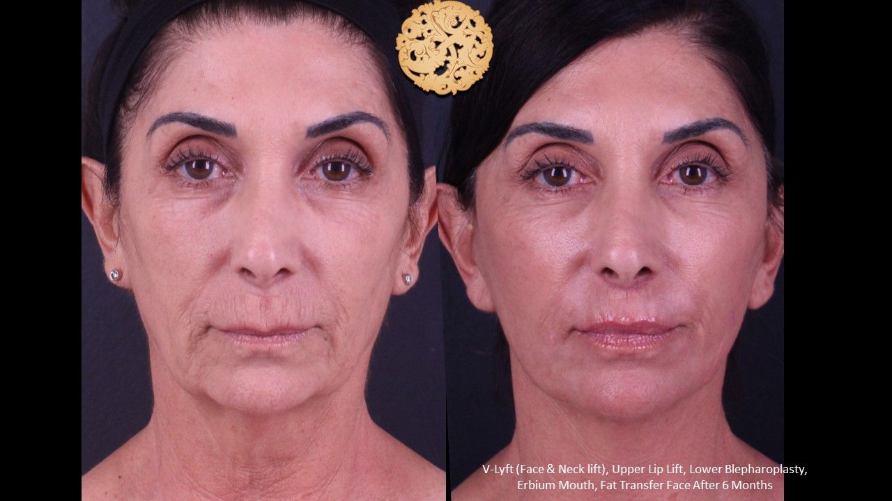 Blepharoplasty result at Nazarian Plastic Surgery