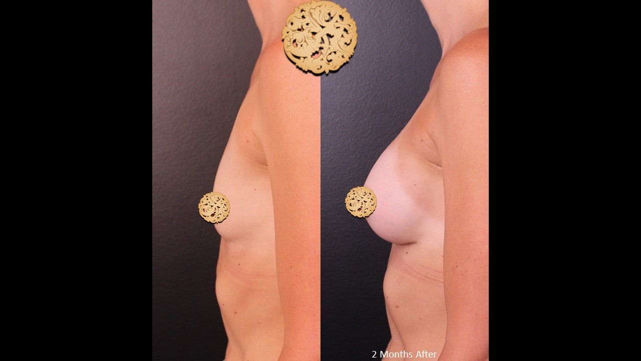 Breast Augmentation result at Nazarian Plastic Surgery