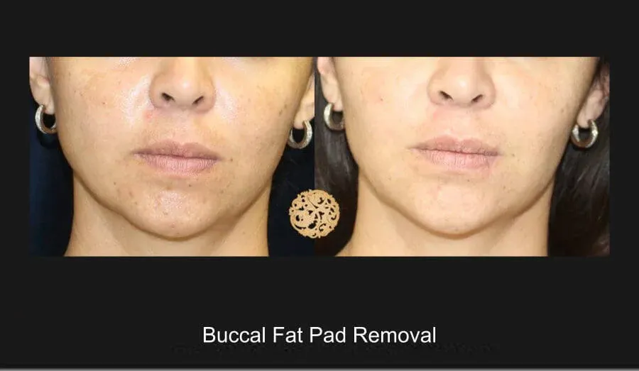 Buccal Fat result at Nazarian Plastic Surgery