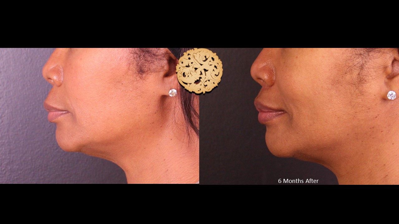 Lip Lift result at Nazarian Plastic Surgery