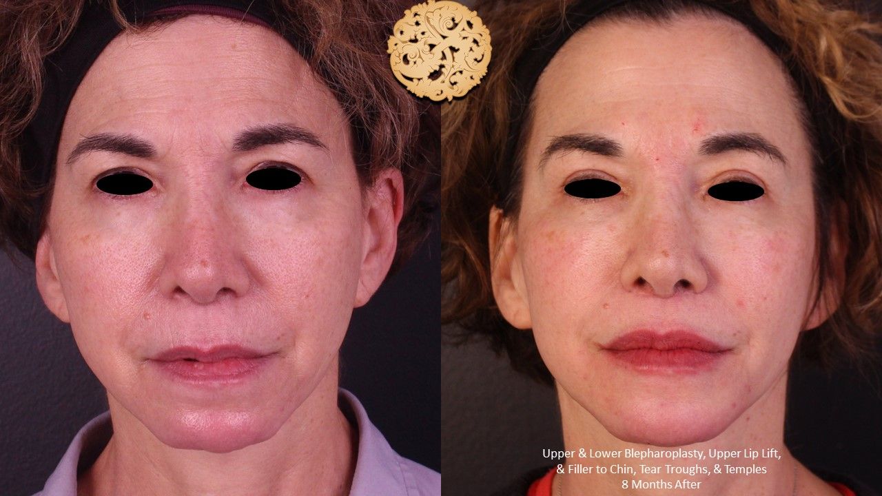 Blepharoplasty result at Nazarian Plastic Surgery