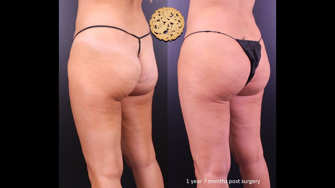 Bbl result at Nazarian Plastic Surgery