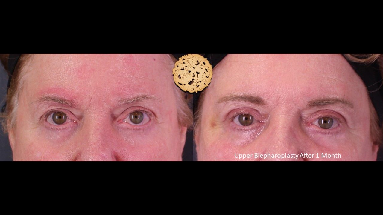 Blepharoplasty result at Nazarian Plastic Surgery