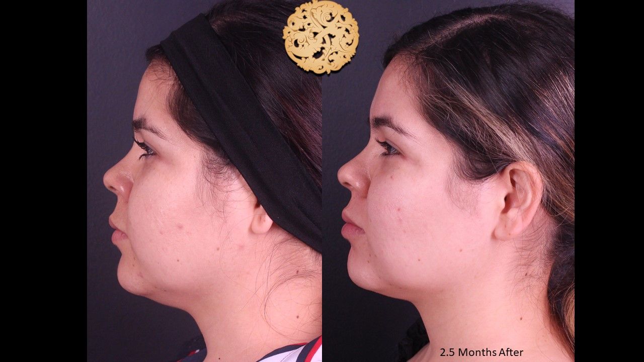 Buccal Fat result at Nazarian Plastic Surgery