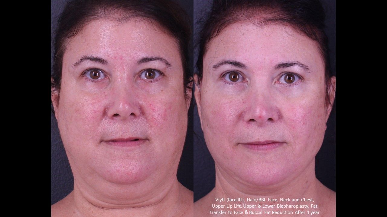 Blepharoplasty result at Nazarian Plastic Surgery