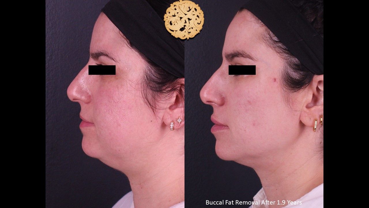 Buccal Fat result at Nazarian Plastic Surgery