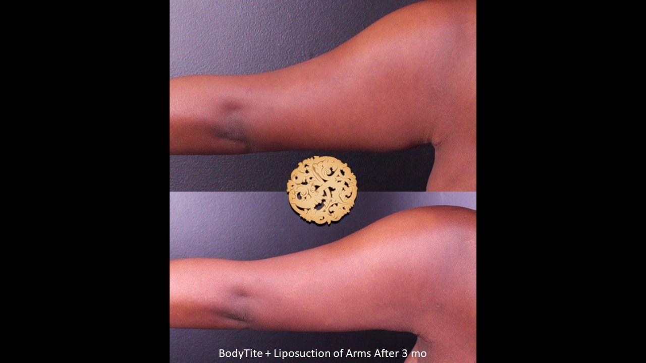 Skin Tightening result at Nazarian Plastic Surgery
