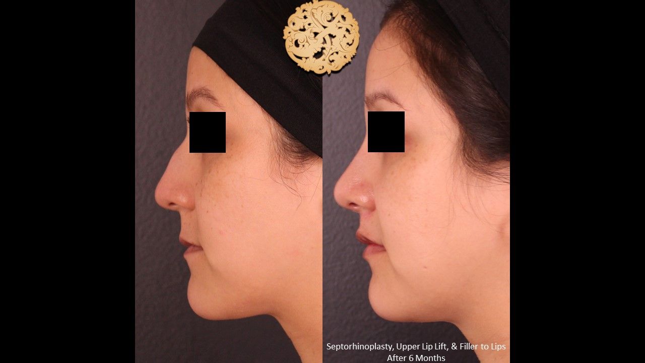 Rhinoplasty result at Nazarian Plastic Surgery