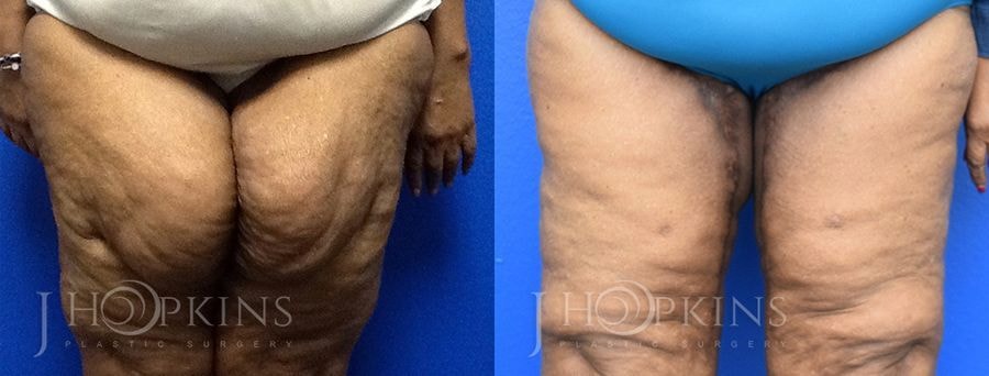 A result from J Hopkins Plastic Surgery