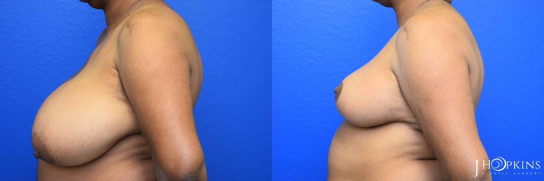 A result from J Hopkins Plastic Surgery