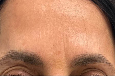 A result from Gregory D. Lewen, MD Oculofacial Plastic Surgery