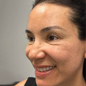 A result from Gregory D. Lewen, MD Oculofacial Plastic Surgery