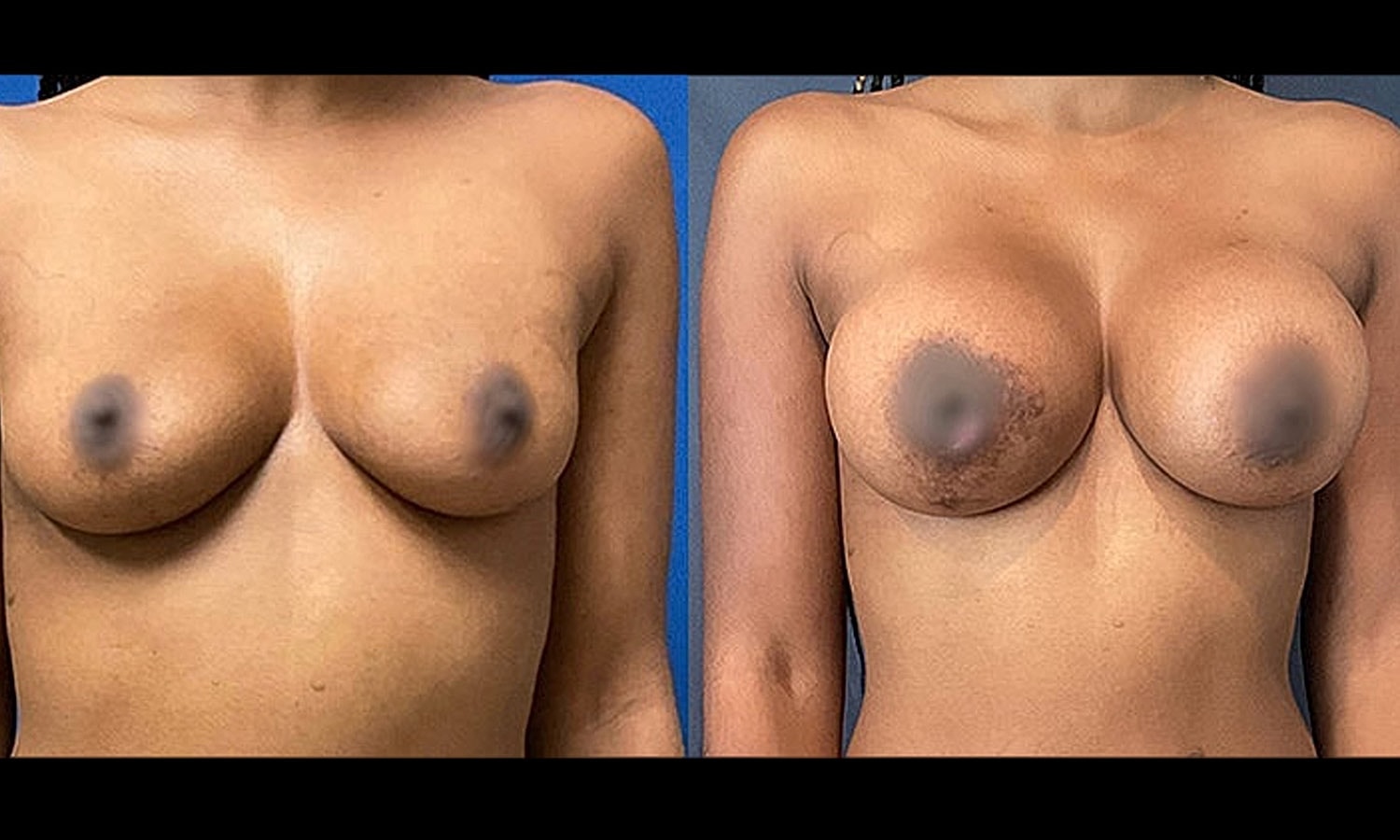 A result from Unfiltered Cosmetic Surgery + Aesthetic Medicine