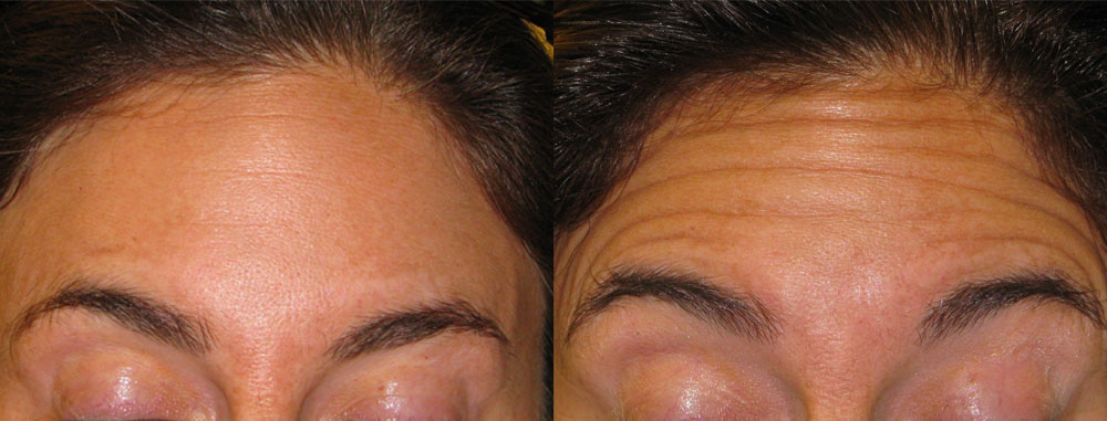 A result from Epi Center MedSpa