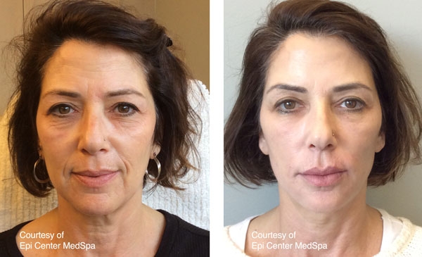 A result from Epi Center MedSpa