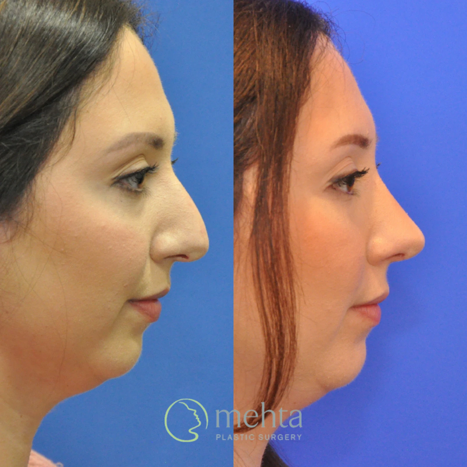 A result from Mehta Plastic Surgery