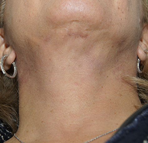 A result from Neal Goldberg, MD