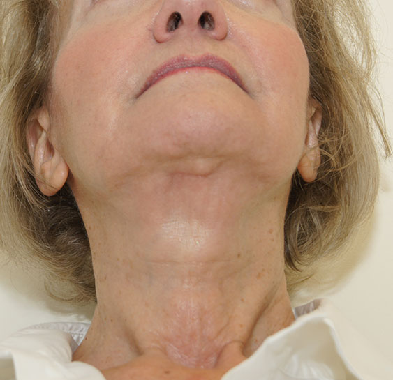 A result from Neal Goldberg, MD