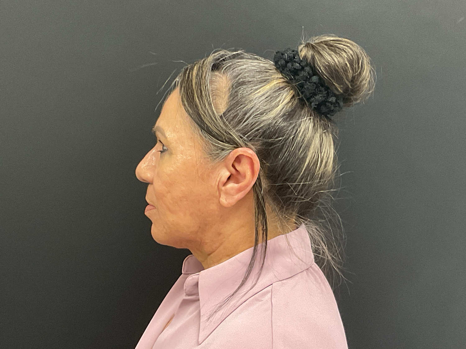A result from Plastic Surgery Center
